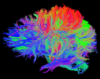 Image: Brain fiber tracts shown in this image are used to obtain connectivity networks, whose diffusion dynamics model dementias. Colors represent the orientation of fibers (Photo courtesy of Neuron). Image: Brain fiber tracts shown in this image are used to obtain connectivity networks, whose diffusion dynamics model dementias. Colors represent the orientation of fibers (Photo courtesy of Neuron).